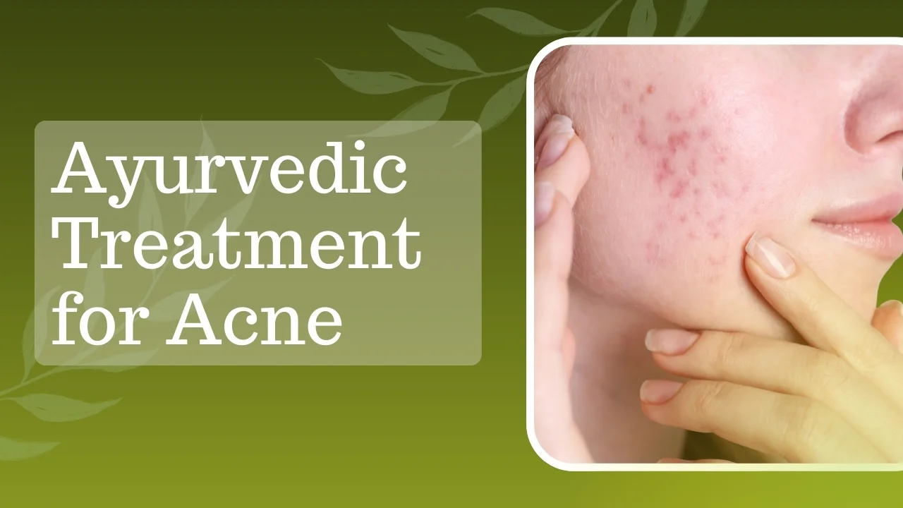 Ayurvedic Treatment for Acne